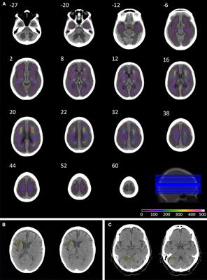 Quantifying the Impact of Chronic Ischemic Injury on Clinical Outcomes in Acute Stroke With Machine Learning